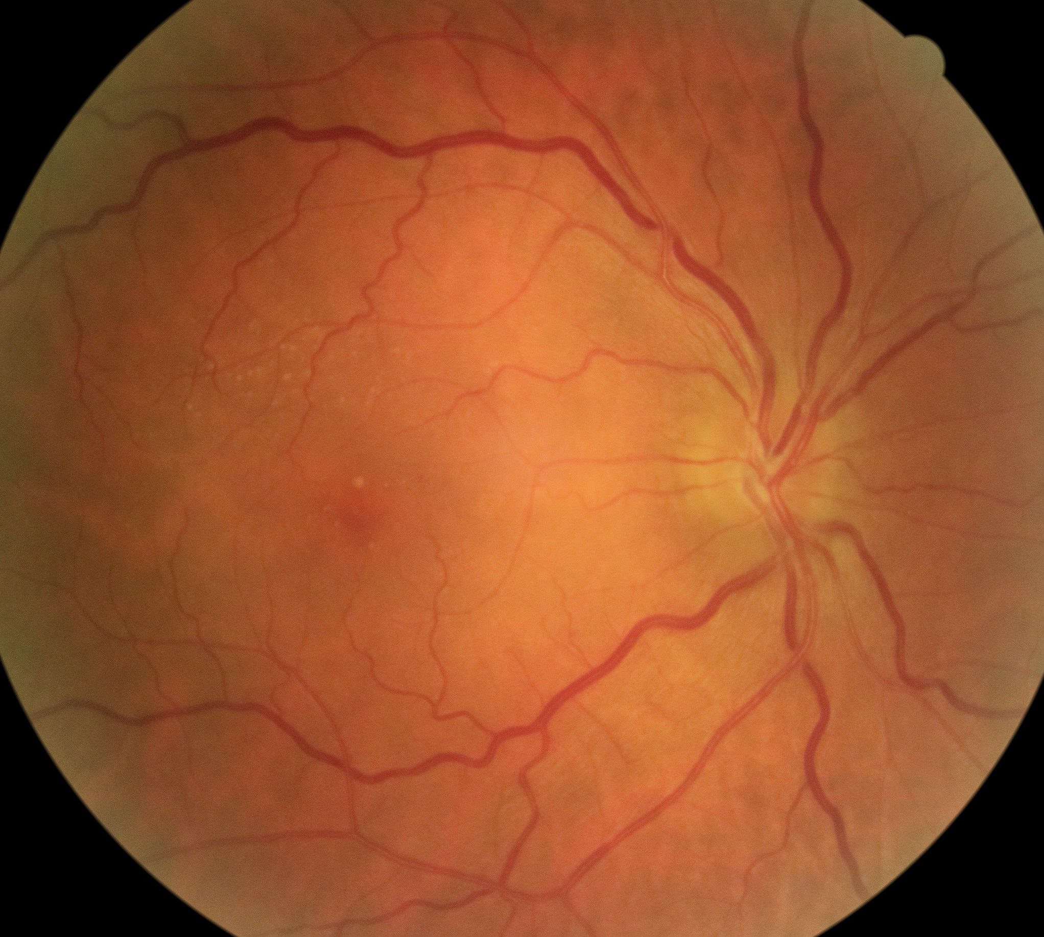Degenerescência Macular da Idade (DMI)